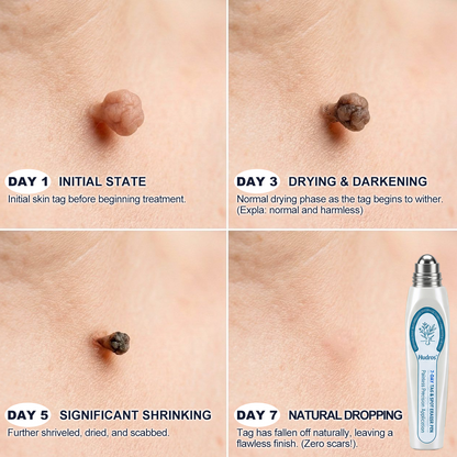 Healrize® 7-𝐷𝑎𝑦 𝗧𝐚𝐠 & 𝗦𝗽𝐨𝐭 𝐄𝐫𝒂𝒔𝒆𝒓(Zero Pain, Zero 𝐒𝐜𝐚𝒓𝒔 Rollerball) 🐳3