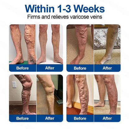 🇬🇧👨‍⚕️👍✅Healrize® VeinTarget Microneedle Patch⚡Instant Relief, Long-Term Results🧡